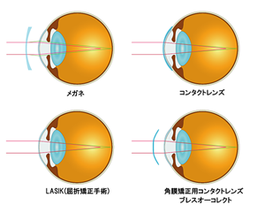 オルソケラトロジー 奈良・生駒-かつらぎ眼科クリニック｜近視矯正治療 寝ている間に視力改善